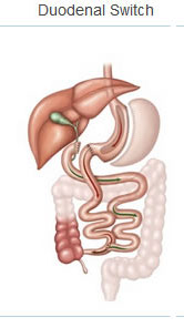 duodenal switch